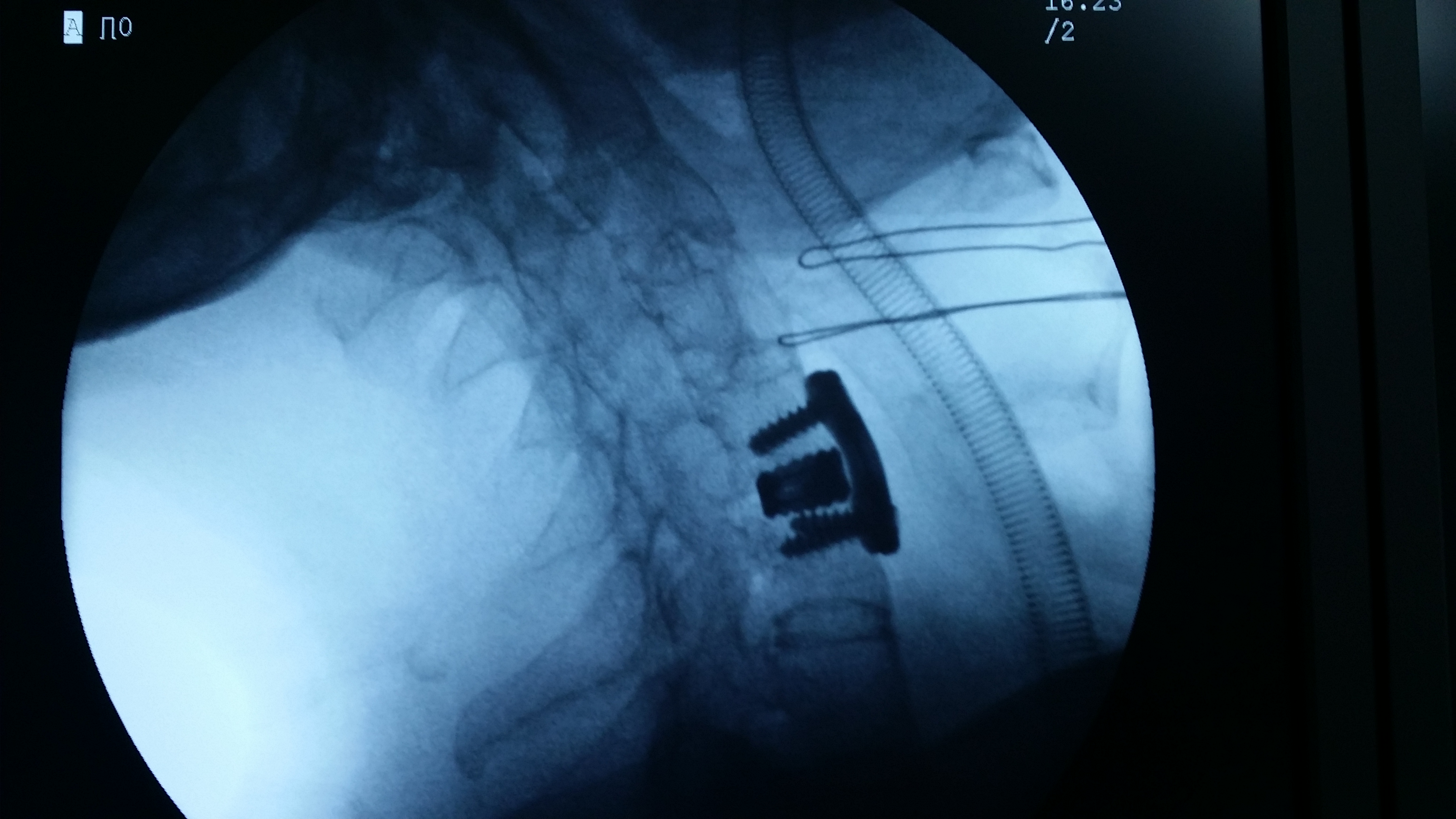 术中颈椎侧位片